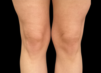 AVAVA Laser Before & After Patient #12236