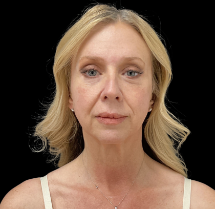 Brow Lift Before & After Patient #12048