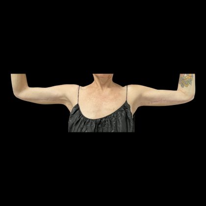Brachioplasty Before & After Patient #12172
