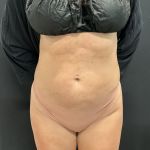 AVAVA Laser Before & After Patient #12235