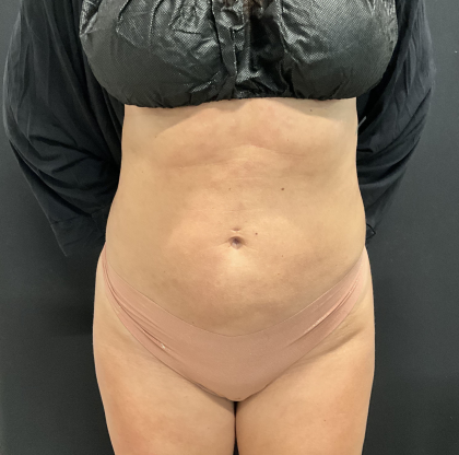 AVAVA Laser Before & After Patient #12235