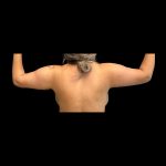 Brachioplasty Before & After Patient #12171