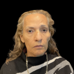 Blepharoplasty Before & After Patient #12227