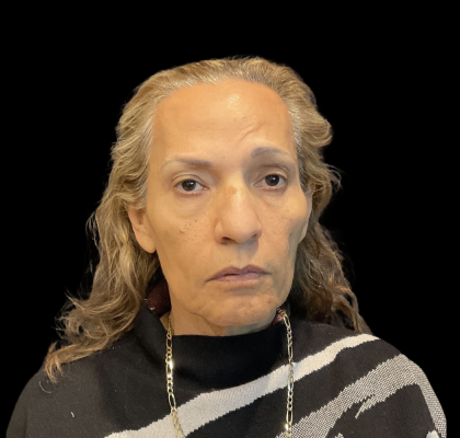 Blepharoplasty Before & After Patient #12227