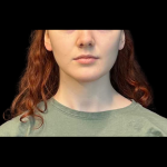 Chin Augmentation Before & After Patient #12230