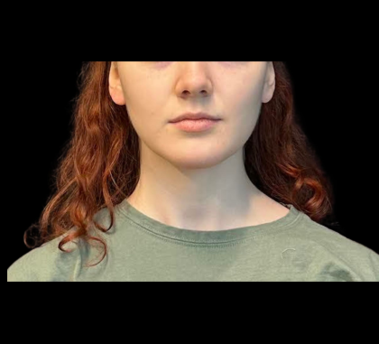 Chin Augmentation Before & After Patient #12230