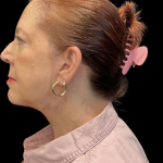 Facelift Before & After Patient #12052