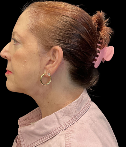 Facelift Before & After Patient #12052