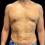High Definition Liposuction Before & After Patient #12037