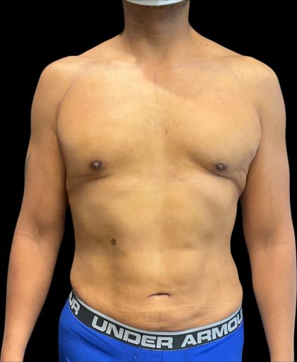 High Definition Liposuction Before & After Patient #12037
