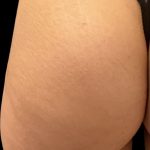 Alloclae Before & After Patient #12055