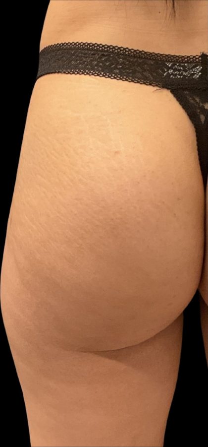 Alloclae Before & After Patient #12055