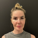 Instalift Before & After Patient #12234