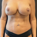 Tummy Tuck Before & After Patient #12247