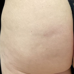 Alloclae Before & After Patient #12054