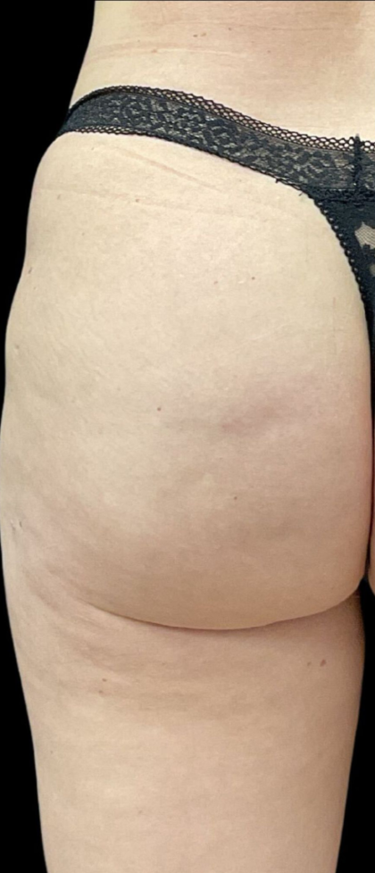 Alloclae Before & After Patient #12054