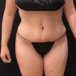Miami Makeover Before & After Patient #12241