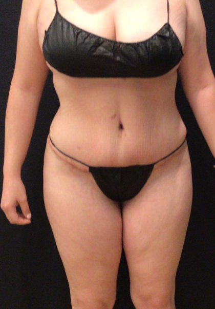 Miami Makeover Before & After Patient #12241