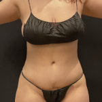 Miami Makeover Before & After Patient #12242