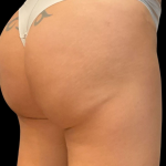 Alloclae Before & After Patient #12058