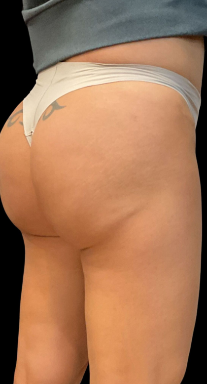 Alloclae Before & After Patient #12058