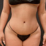 Miami Makeover Before & After Patient #12243