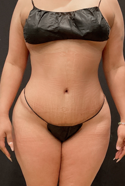 Miami Makeover Before & After Patient #12243
