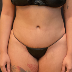 Tummy Tuck Before & After Patient #12246