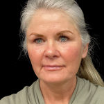 Brow Lift Before & After Patient #12050
