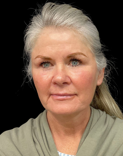 Brow Lift Before & After Patient #12050