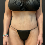 Tummy Tuck Before & After Patient #12457