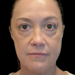 AVAVA Laser Before & After Patient #12237