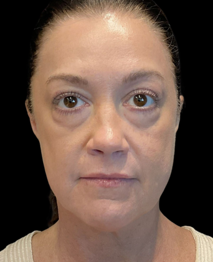 AVAVA Laser Before & After Patient #12237