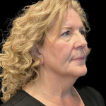 AVAVA Laser Before & After Patient #12238