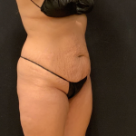 Miami Makeover Before & After Patient #12240