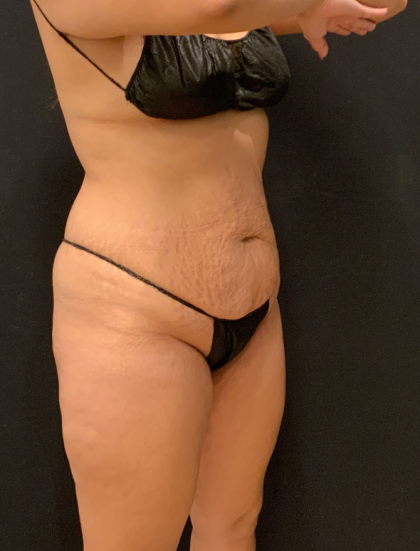 Miami Makeover Before & After Patient #12240
