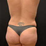 Miami Makeover Before & After Patient #12244