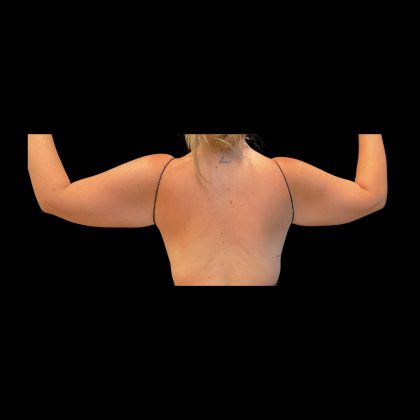 Brachioplasty Before & After Patient #12174