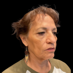 Blepharoplasty Before & After Patient #12227