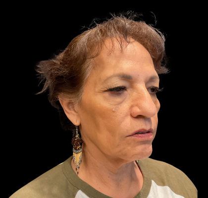 Blepharoplasty Before & After Patient #12227