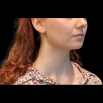 Chin Augmentation Before & After Patient #12230
