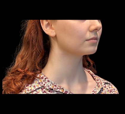 Chin Augmentation Before & After Patient #12230
