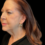 Facelift Before & After Patient #12052