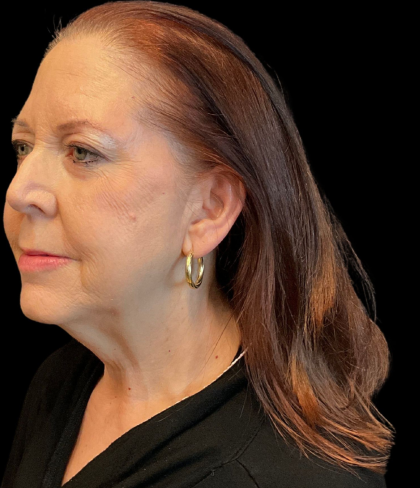 Facelift Before & After Patient #12052