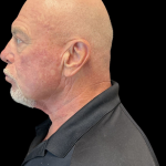 Blepharoplasty Before & After Patient #12039