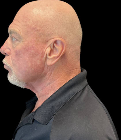 Blepharoplasty Before & After Patient #12039
