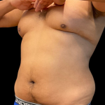 High Definition Liposuction Before & After Patient #12037
