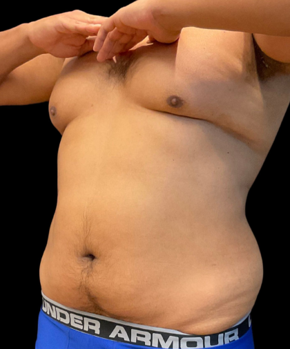 High Definition Liposuction Before & After Patient #12037