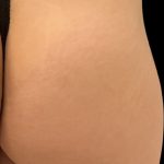 Alloclae Before & After Patient #12055