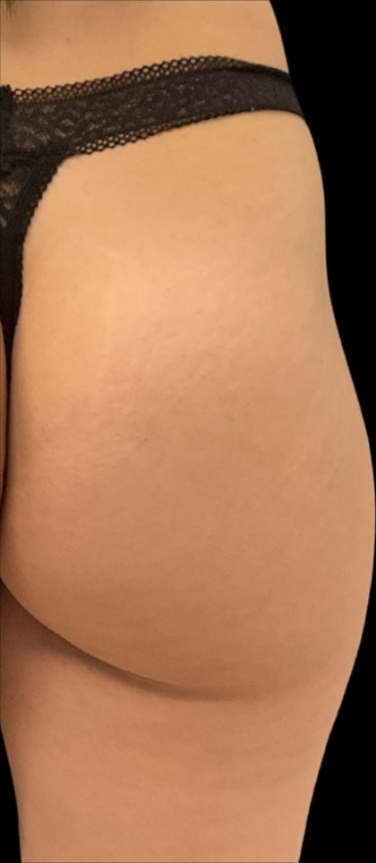 Alloclae Before & After Patient #12055